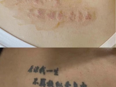 曹县专业去除纹身效果好图1
