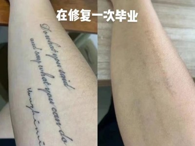 曹县专业激光洗纹身图1