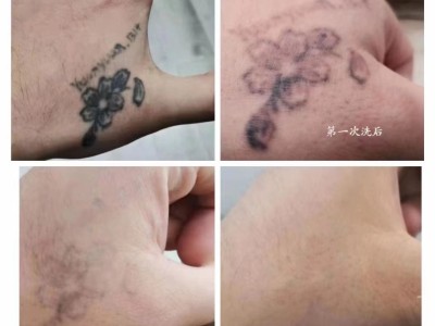 菏泽曹县洗纹身超皮秒洗纹身价格图3