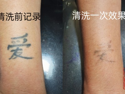 菏泽曹县洗纹身超皮秒洗纹身价格图2